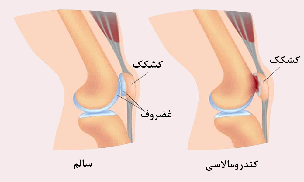 کندرومالاسی یا نرمی کشکک زانو از علل صدا دادن و تق تق زانو 