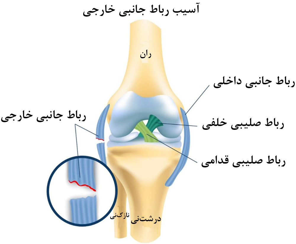 پارگی رباط از دلایل قفل شدن واقعی زانو