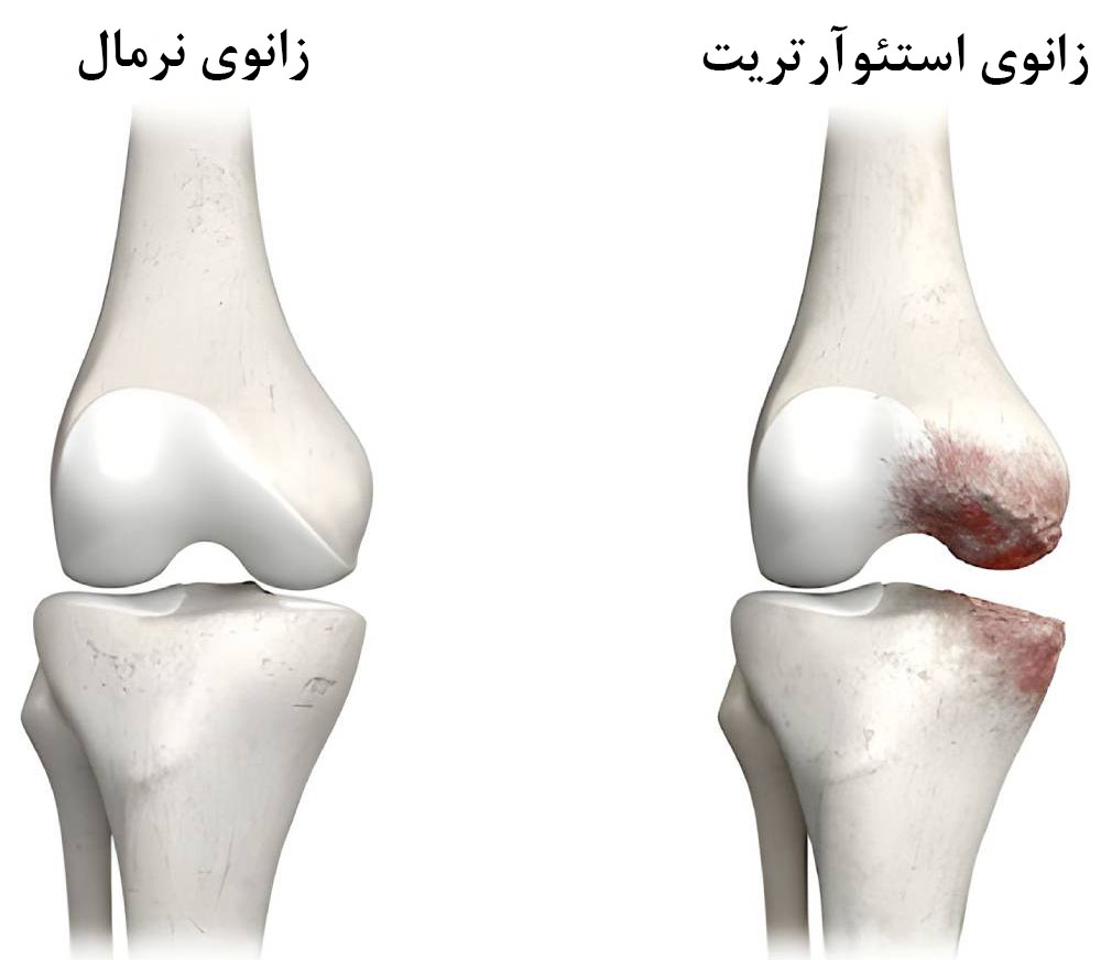 آرتروز از دلایل قفل شدن واقعی زانو