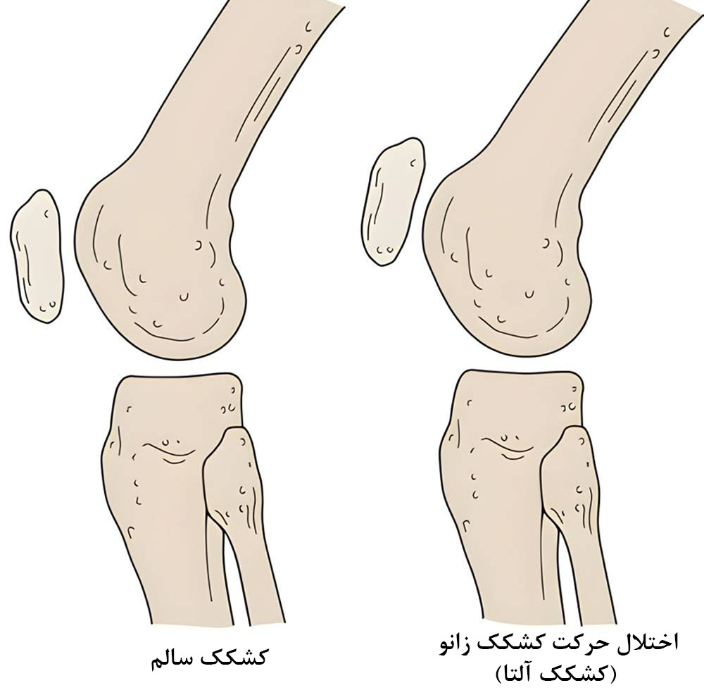 اختلال حرکت کشکک زانو از دلایل قفل شدن کاذب زانو 