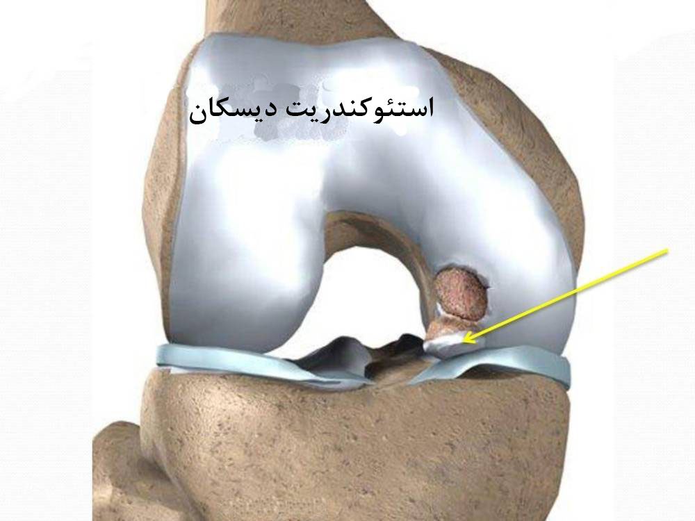 استئوکندرتریت دیسکان از دلایل قفل شدن واقعی زانو