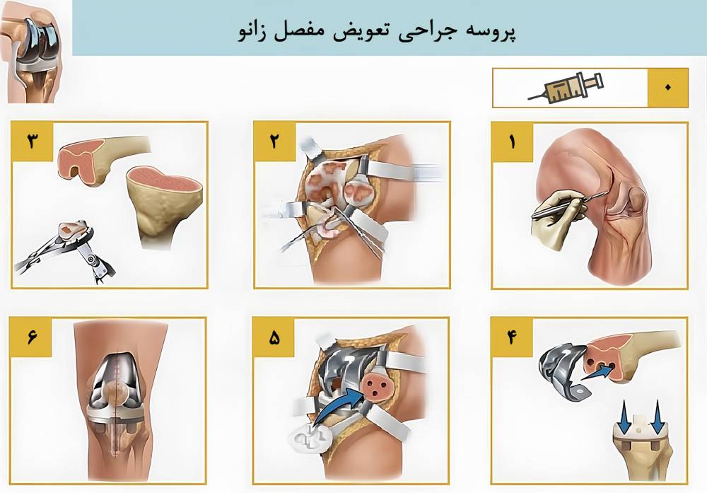 جراحی تعویض مفصل زانو چگونه انجام می‌شود؟