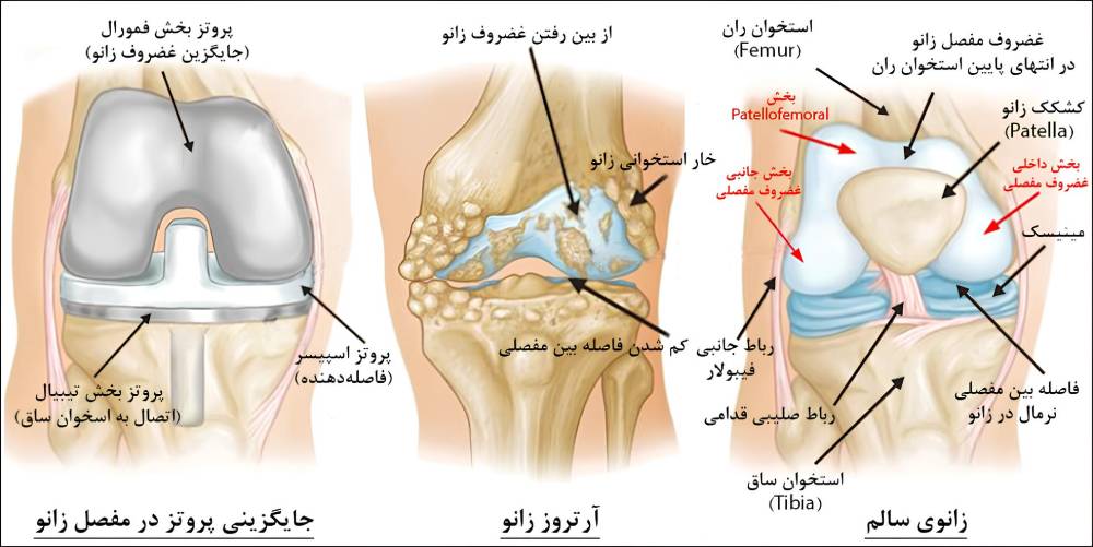 جراحی تعویض مفصل زانو چیست؟