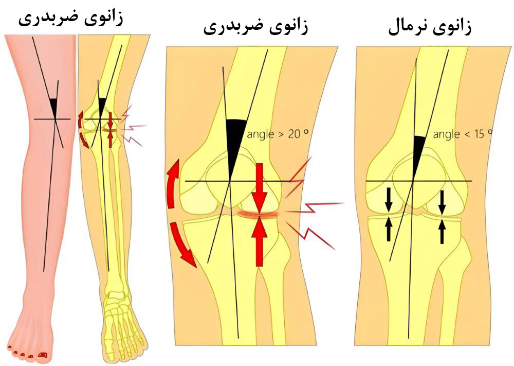 زانوی ضربدری چیست؟