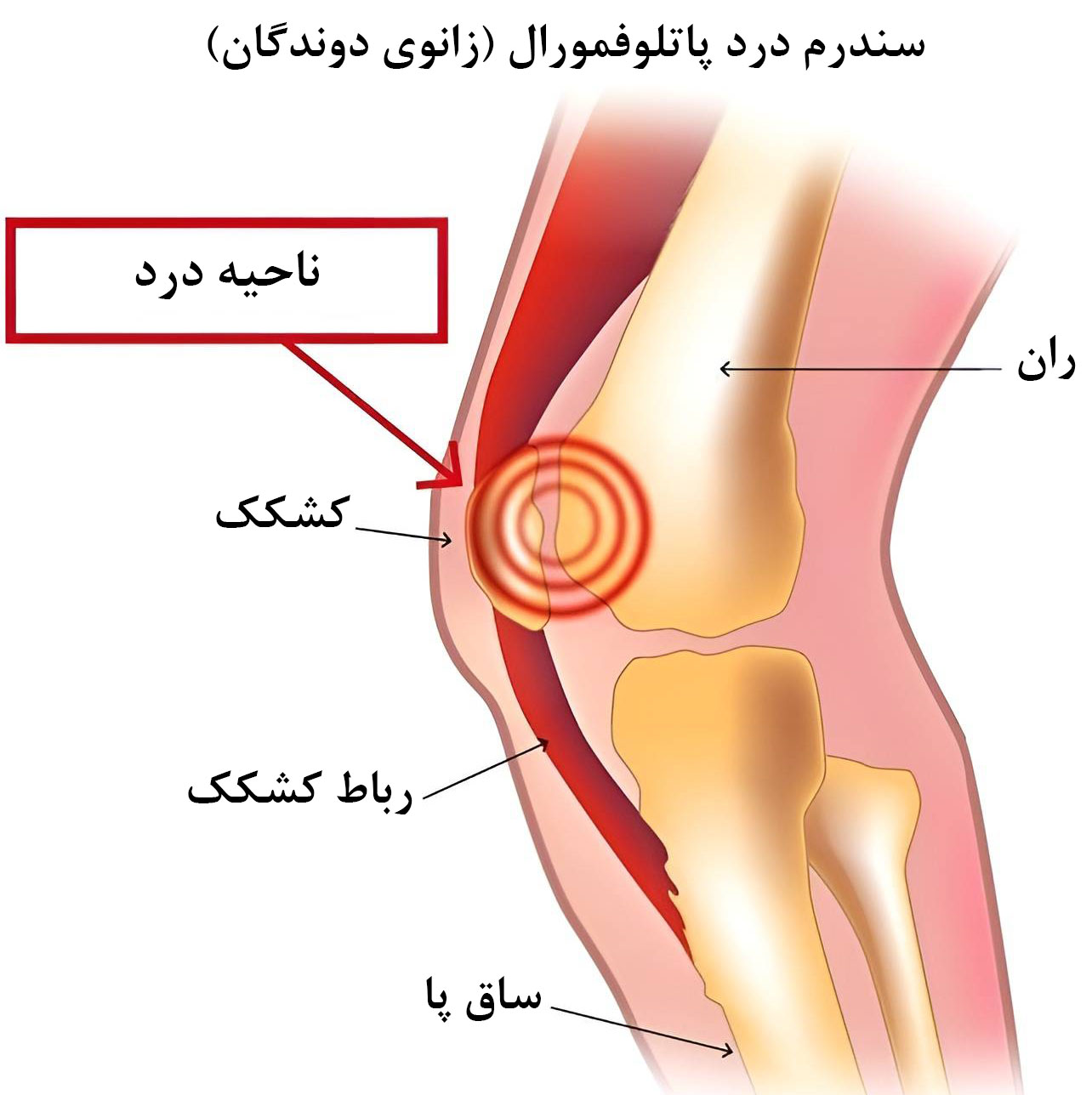 سندرم درد پاتلوفمورال یا زانوی دوندگان از علل صدا دادن و تق تق زانو 