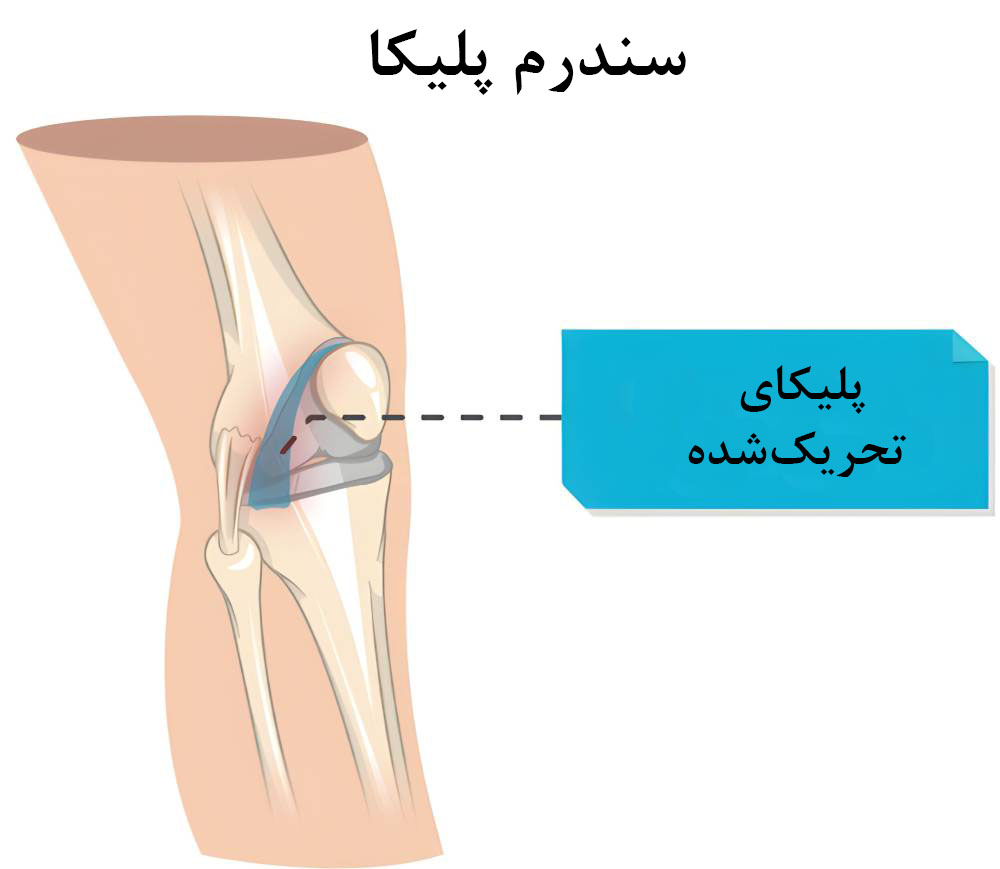 سندرم پلیکا از علل صدا دادن و تق تق زانو 