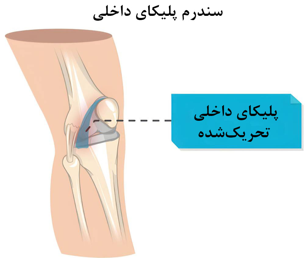 سندرم پلیکا از دلایل قفل شدن کاذب زانو 