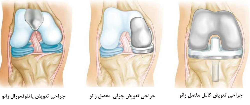 انواع عمل تعویض مفصل زانو