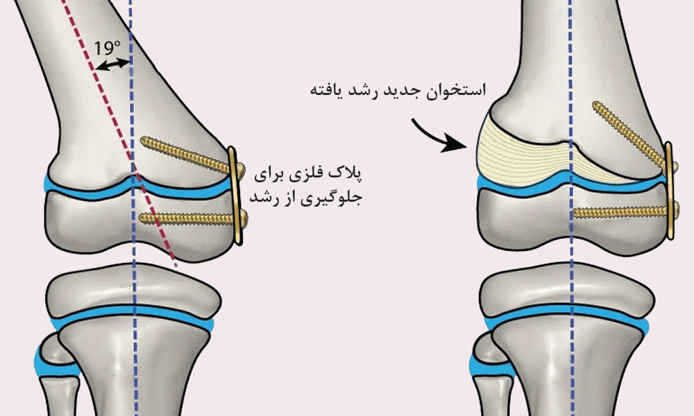 جراحی زانوی ضربدری با هدایت رشد استخوان 