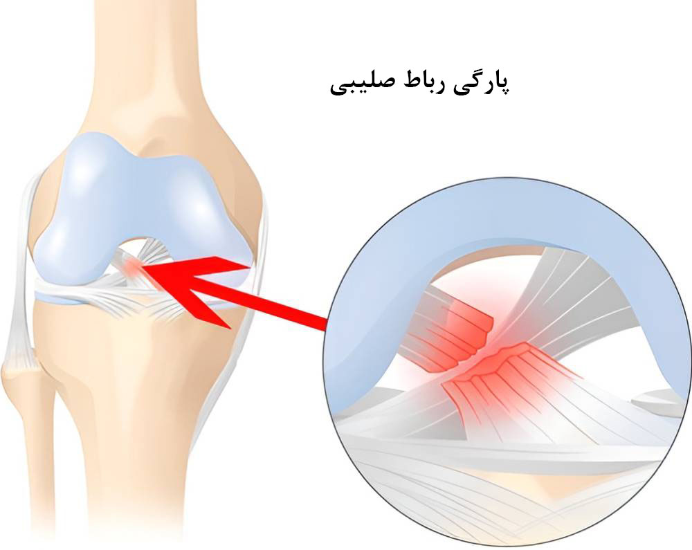 پارگی رباط زانو از علل صدا دادن و تق تق زانو 