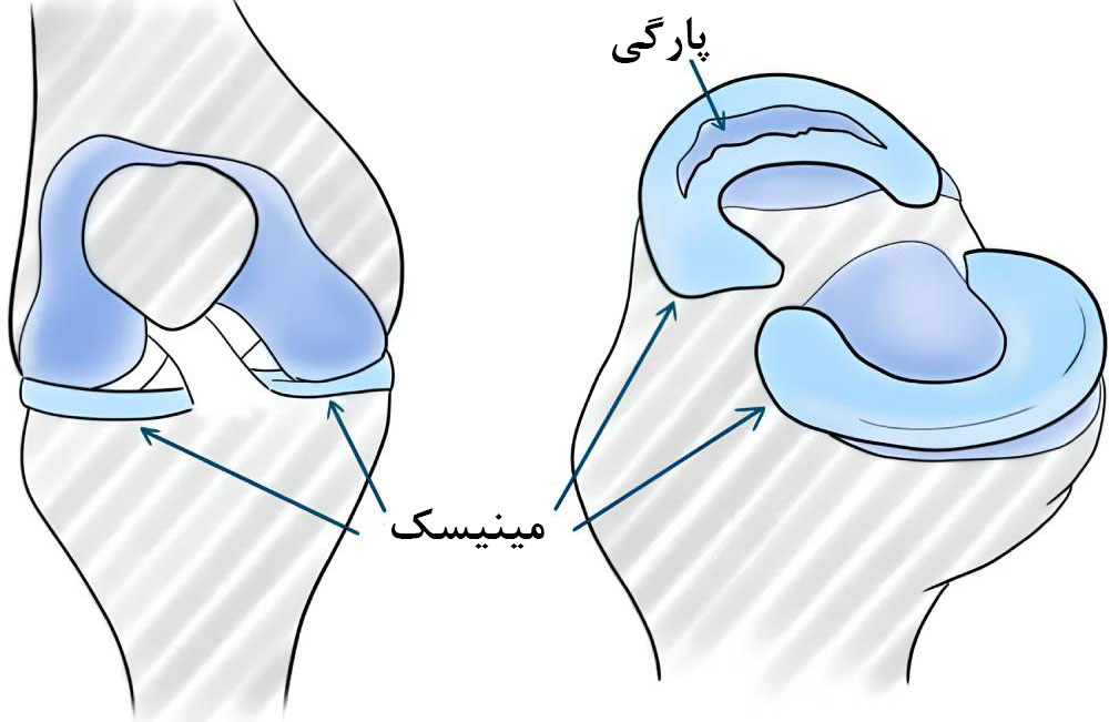 پارگی مینیسک از دلایل قفل شدن واقعی زانو