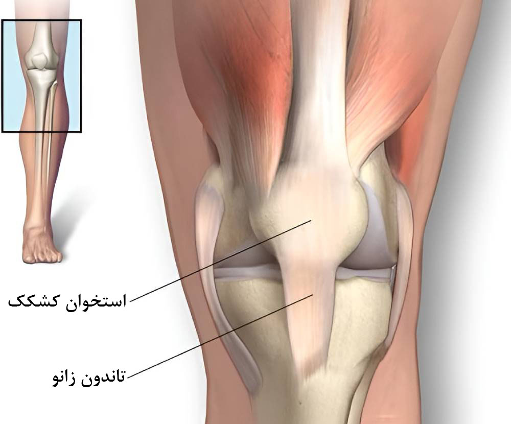 کشیدگی و پارگی تاندون زانو چیست؟