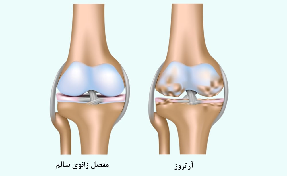 آرتروز زانو چیست؟