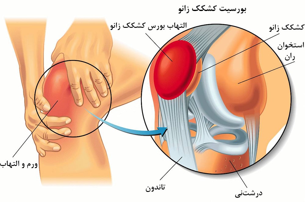 بورسیت زانو چیست؟