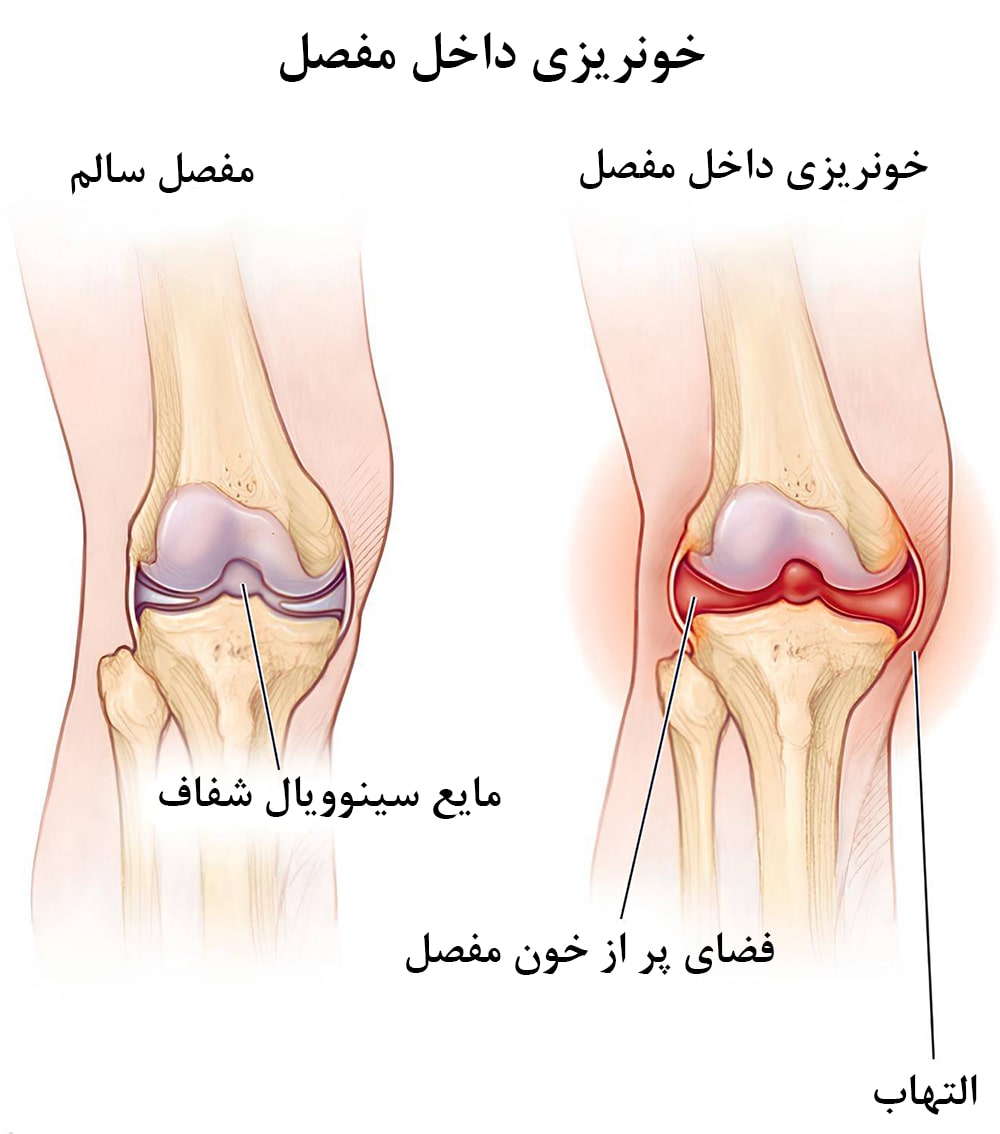 خونریزی داخل مفصل زانو