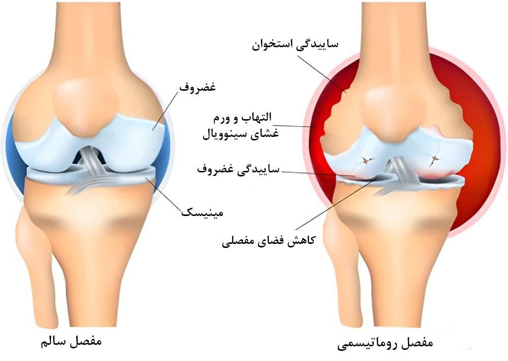 روماتیسم زانو