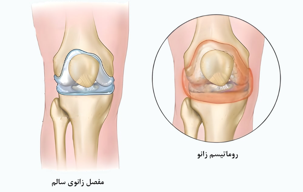 روماتیسم زانو