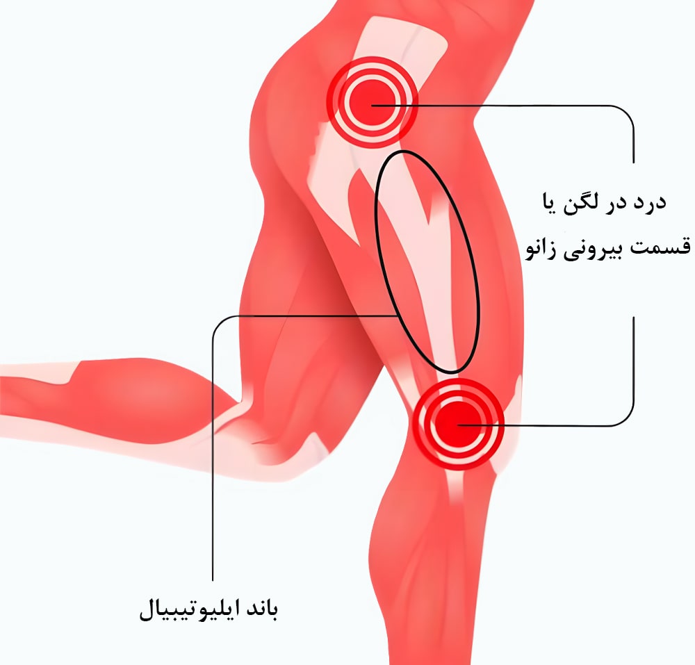 سندرم باند ایلیوتیبیال (ITB)