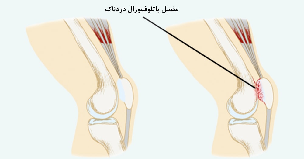 سندرم درد پاتلوفمورال (زانوی دوندگان)