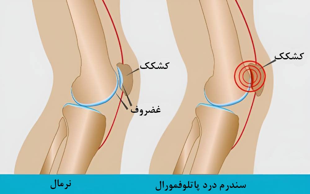 سندرم درد پاتلوفمورال یا زانوی دوندگان 