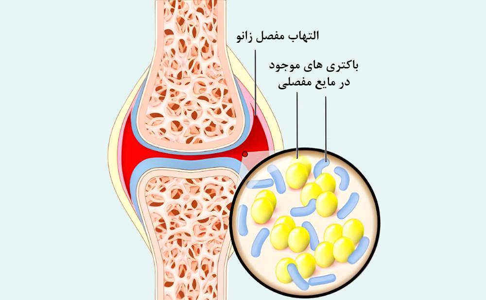 عفونت مفصلی زانو