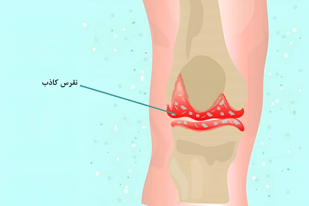 نقرس کاذب 