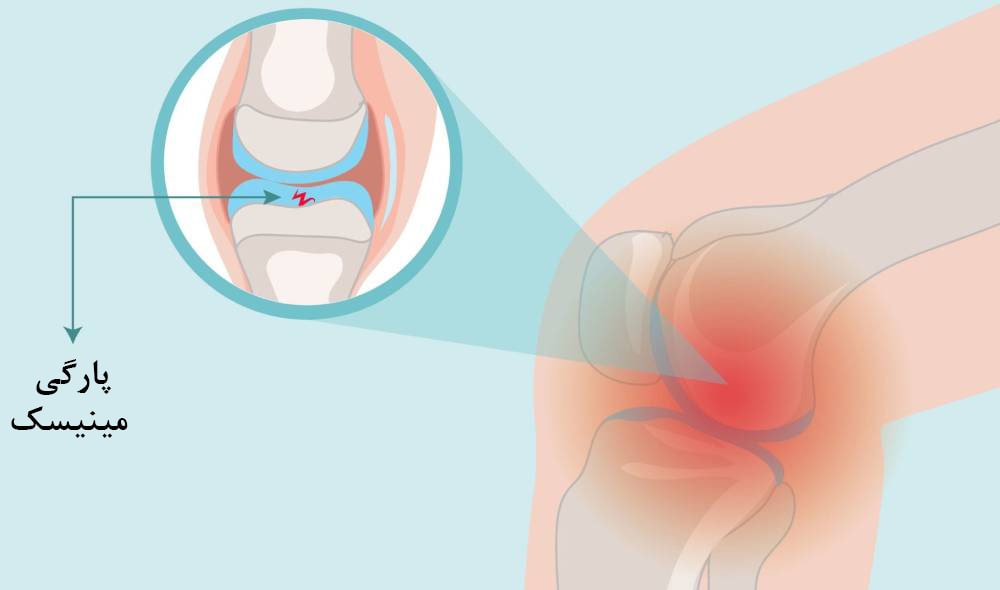 پارگی مینیسک زانو