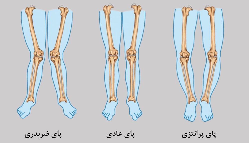 پای ضربدری و پای پرانتزی