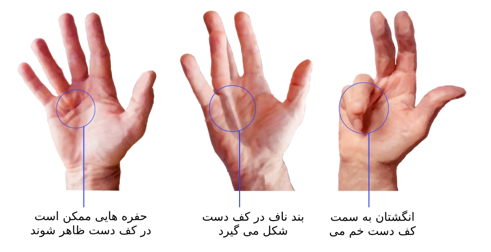 انقباض دوپویترون