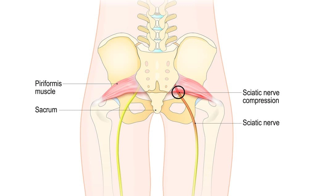 فشردگی عصب سیاتیک