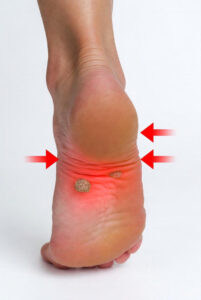 خارپاشنه چیست و چطور درمان میشود