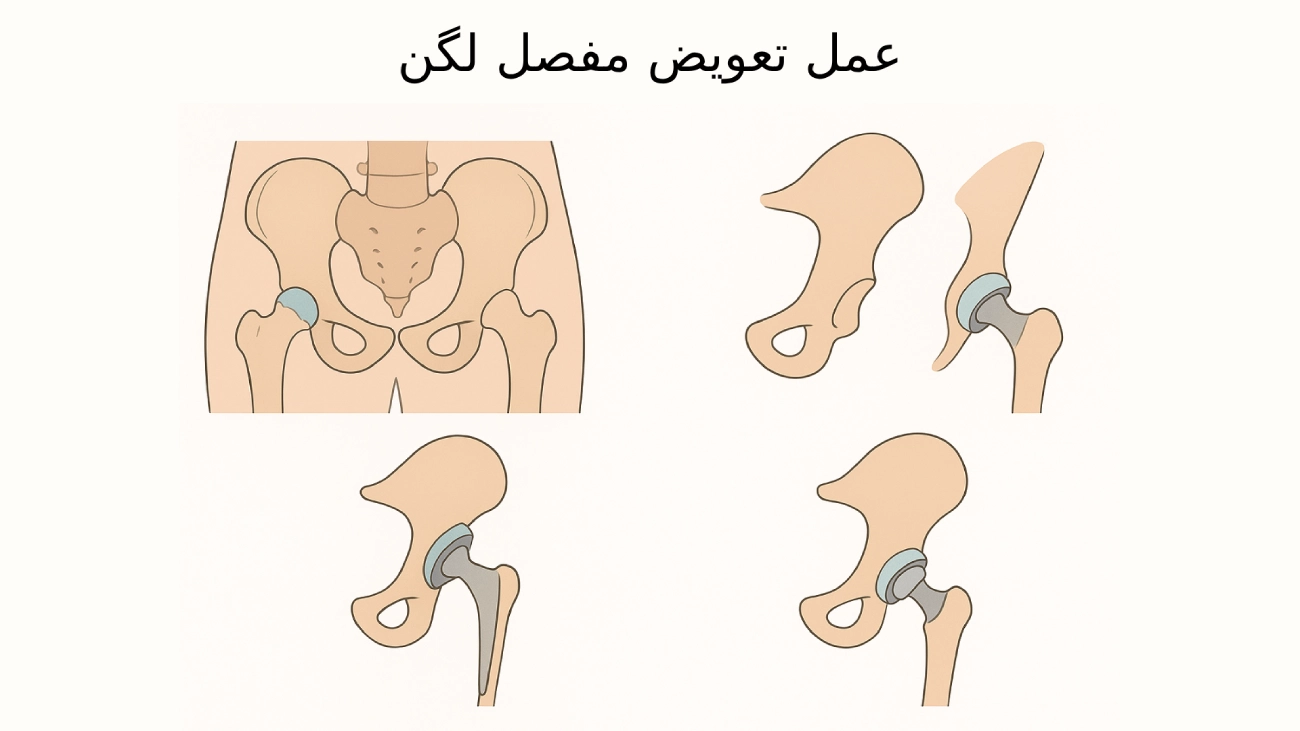 جراحی عمل تعویض لگن