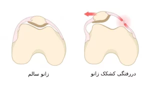 دررفتگی کشکک زانو