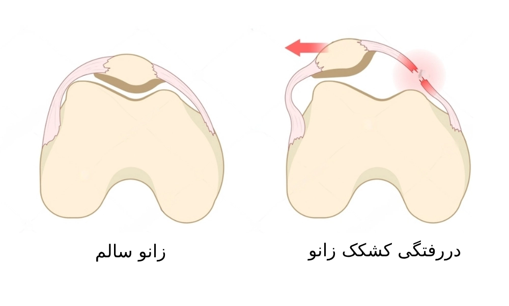 دررفتگی کشکک زانو