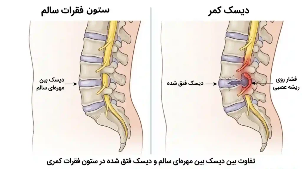 علائم دیسک کمر