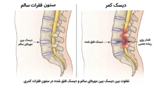 علائم دیسک کمر