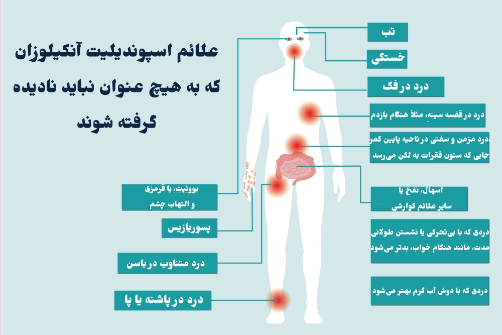 علائم اسپوندیلیت آنکیلوزان