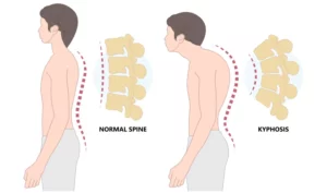 کیفوز یا گوژپشتی