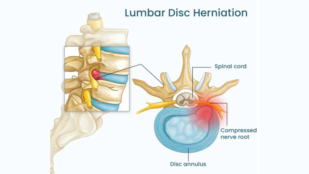 فتق دیسک کمر