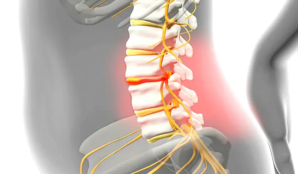 علائم فتق دیسک کمر