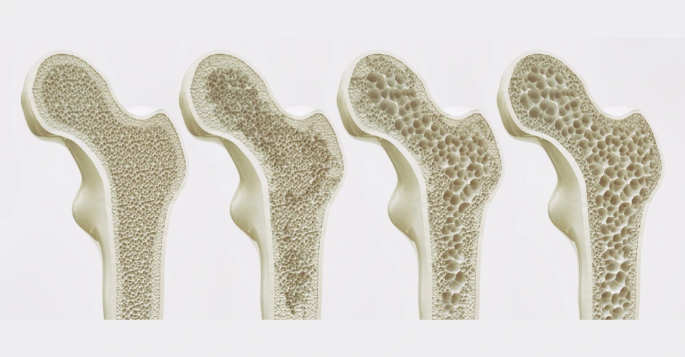 تراکم استخوان