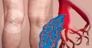 ترومبوز سیاهرگی عمقی