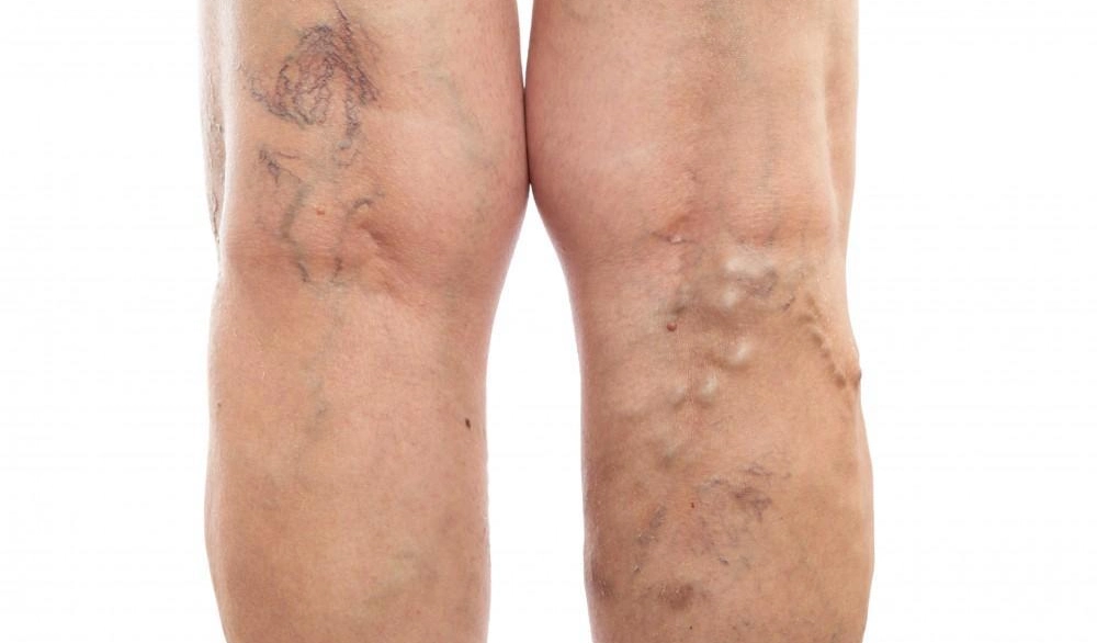 ترومبوز سیاهرگی عمقی