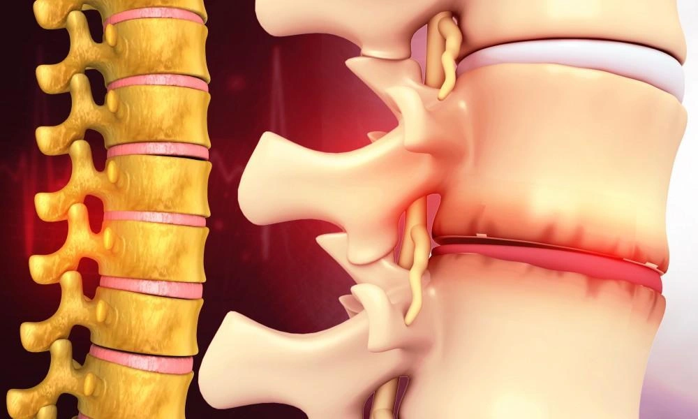 بیماری دژنراتیو