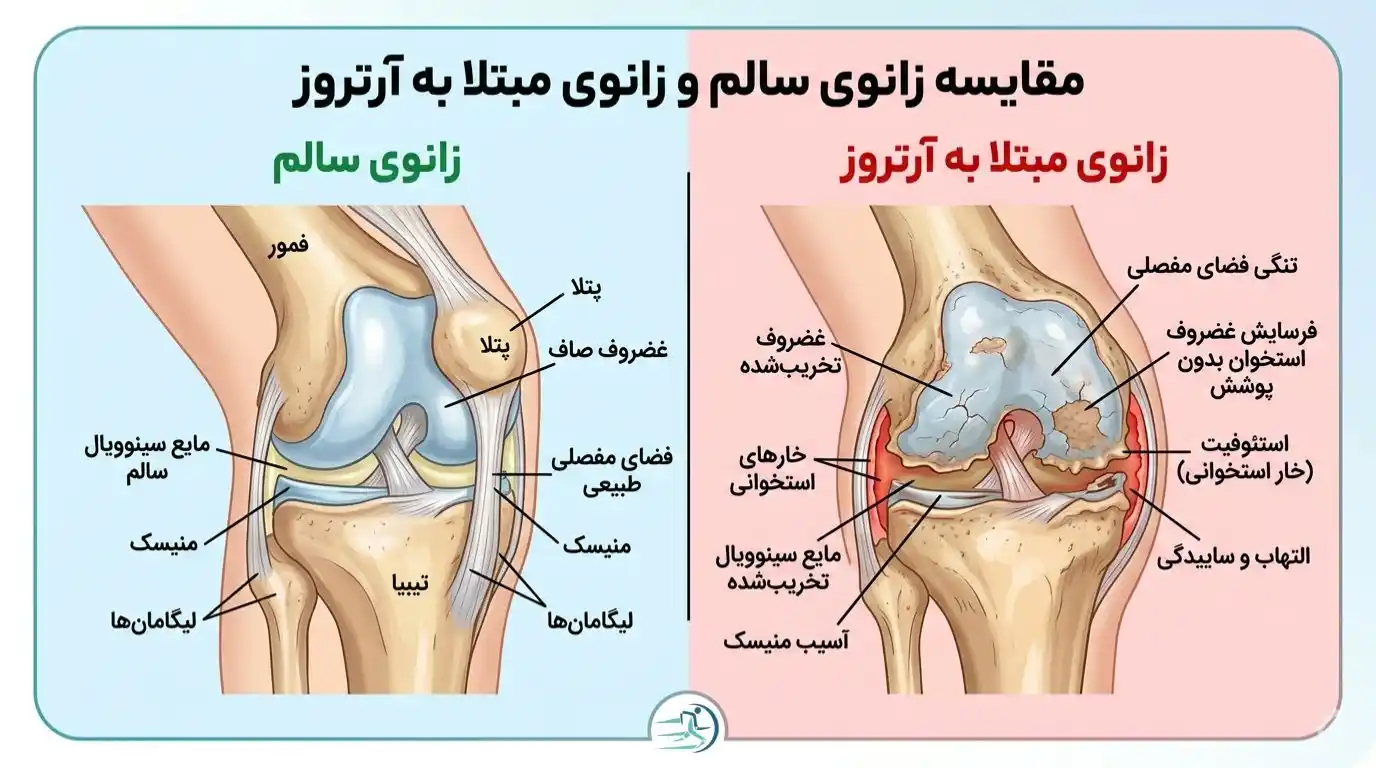 مقایسه زانوی سالم با زانوی مبتلا به آرتروز