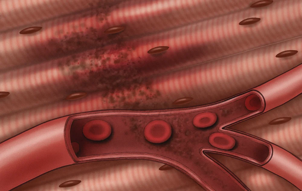 رابدومیولیز