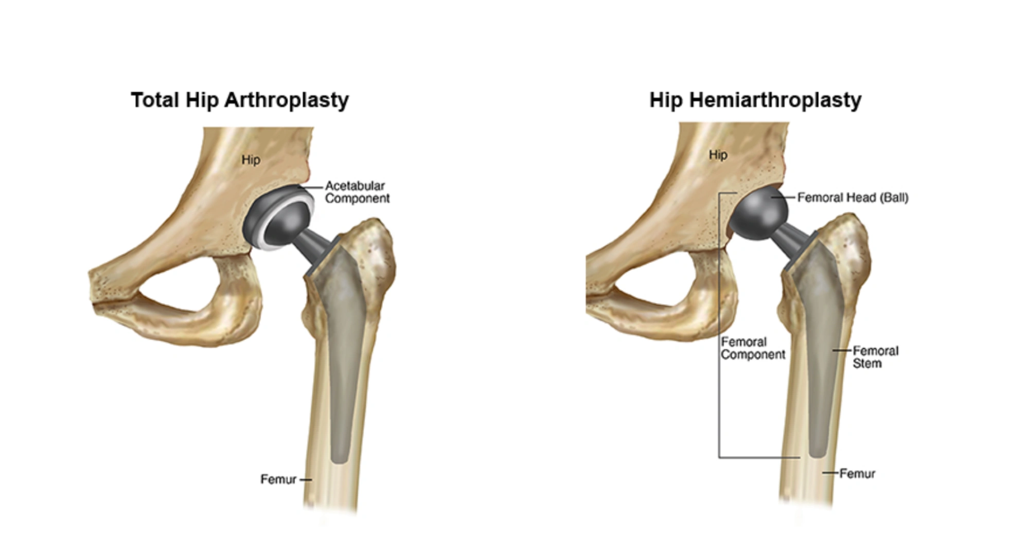 تفاوت پروتز لگن کامل و نیمه