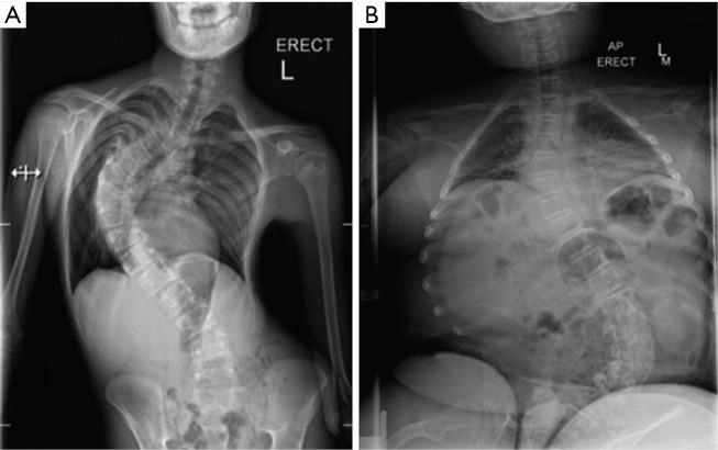 درمان دیستروفی عضلانی
