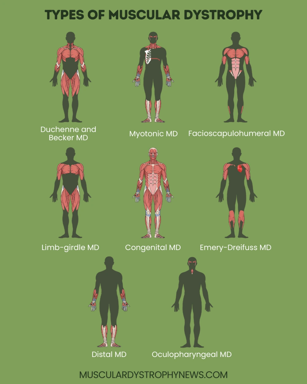 انواع دیستروفی عضلانی