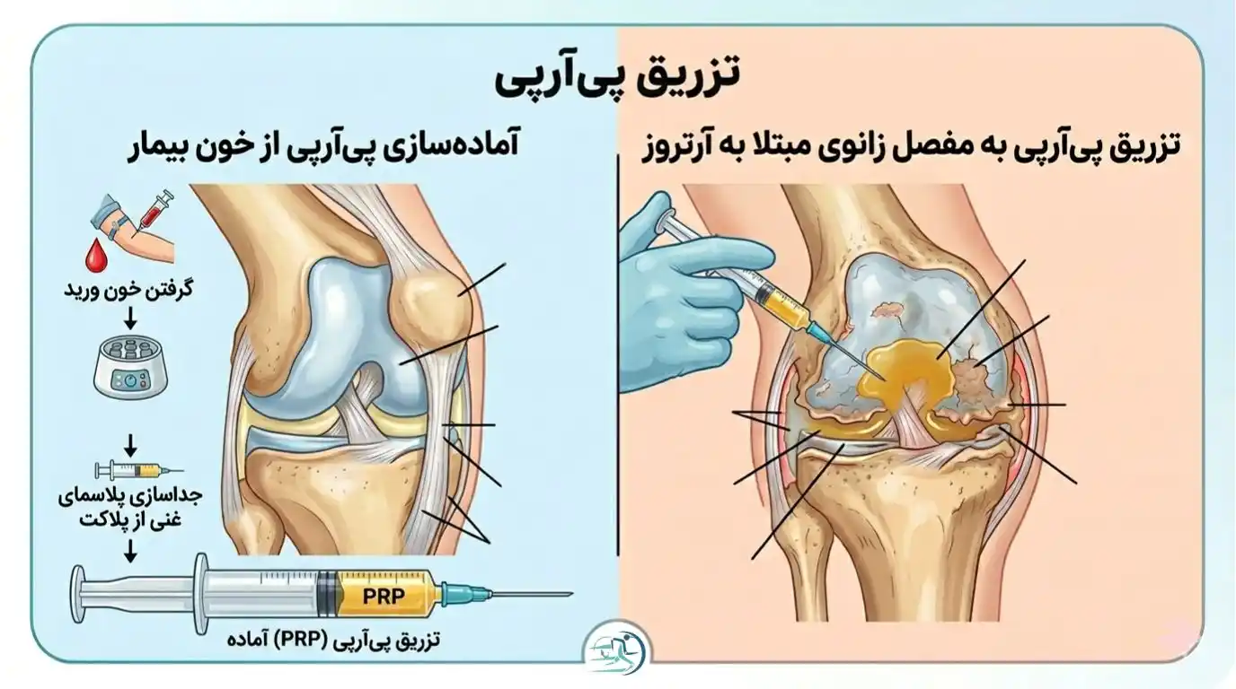 عمل پی آر پی زانو